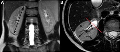 A Comparability of Renal Length and Volume Measurements in MRI and Ultrasound in Children